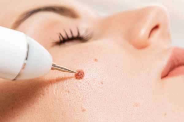 CryoPen: 5 Skin Concerns It May Be Used to Treat 3 What actually happens during a CryoPen treatment Maidstone?