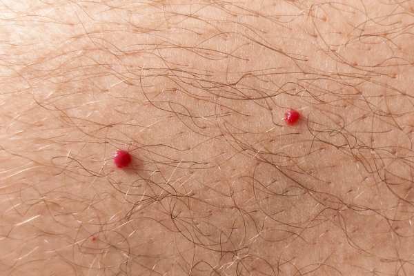 CryoPen: 5 Skin Concerns It May Be Used to Treat 2 cherry angioma removal Maidstone