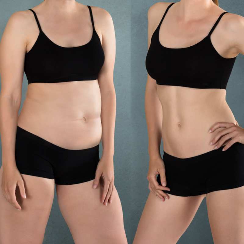 Does Fat Freezing at Home Work? DIY Devices vs Professional Cryolipolysis 2 before and after Cryolipolysis Maidstone