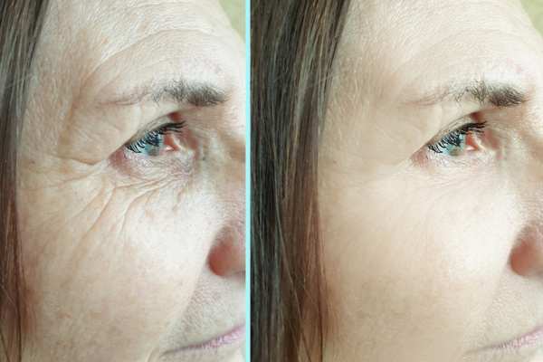 Why Do People Choose HIFU for a Non-Surgical Facelift? 4 How long can HIFU results last Maidstone?