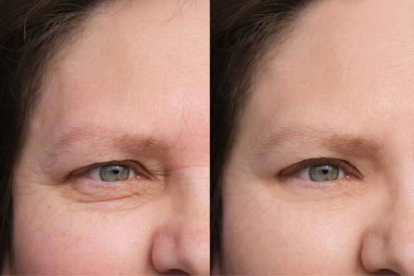 HIFU vs Botulinum Toxin: Understanding the Differences 4 How long do HIFU results last Maidstone?