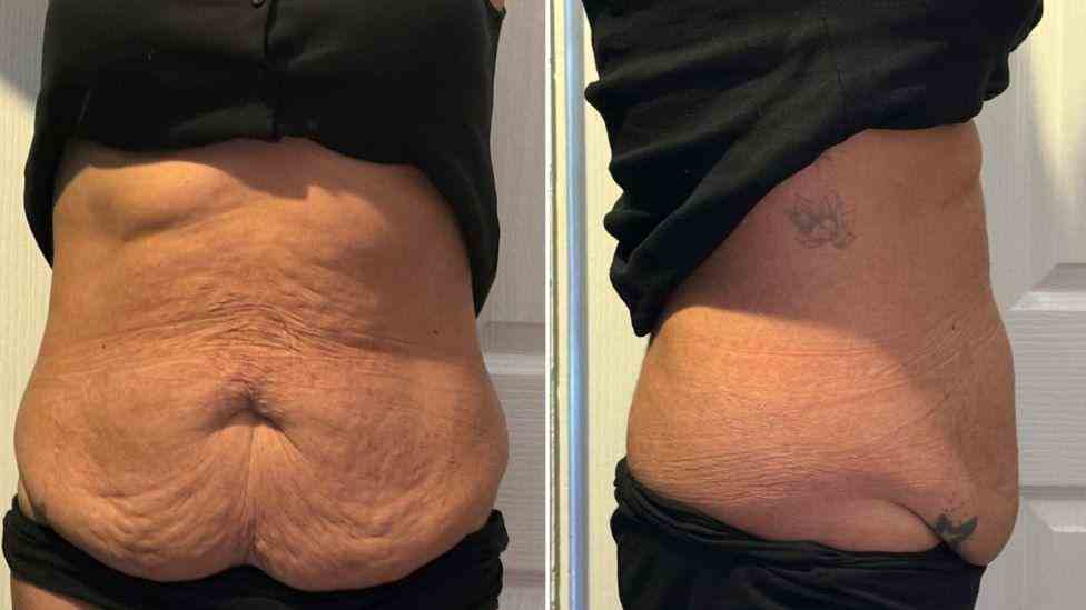 Lost the Weight but Not the Loose Skin? What You Should Know 1 Is It Definitely Loose Skin Maidstone?